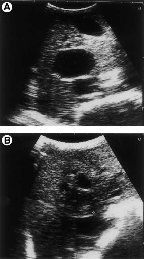 April 2002 PEDIM FOR TREATMENT OF LIVER HYDATID DISEASE 959 Figure 2. (A) Serial sonograms of sheep 8; pure anechoic cyst before treatment in the right lobe of liver (between cursors).
