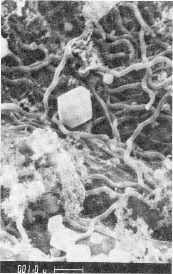 518 WILLY BURGDORFER FIG. 2. Lyme disease spirochetes in midgut of Ixodes dammini from Shelter Island, New York. Hemoglobin crystals in the center and on bottom of picture (scanning Ei.