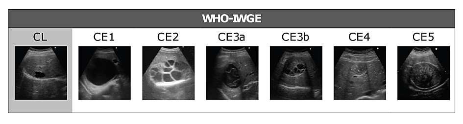 Sonographic features of CE cysts WHO-IWGE, 2003. International classification of ultrasound images in cystic echinococcosis for application in clinical and field epidemiological settings.