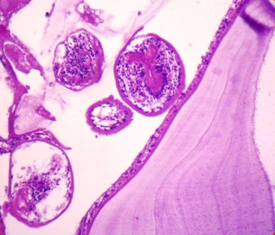 DIAGNOSIS of Cystic Echinococcosis: cytology Biopsies and punctures may also be