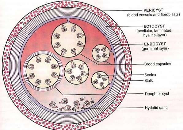 Cysts (with the exception of bone) are composed of -PERICYST (host reactive tissue) -ENDOCYST
