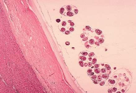 >> protoscolices = pre adult -free daughter cysts (+/- laminar layer) in some stages -hydatid