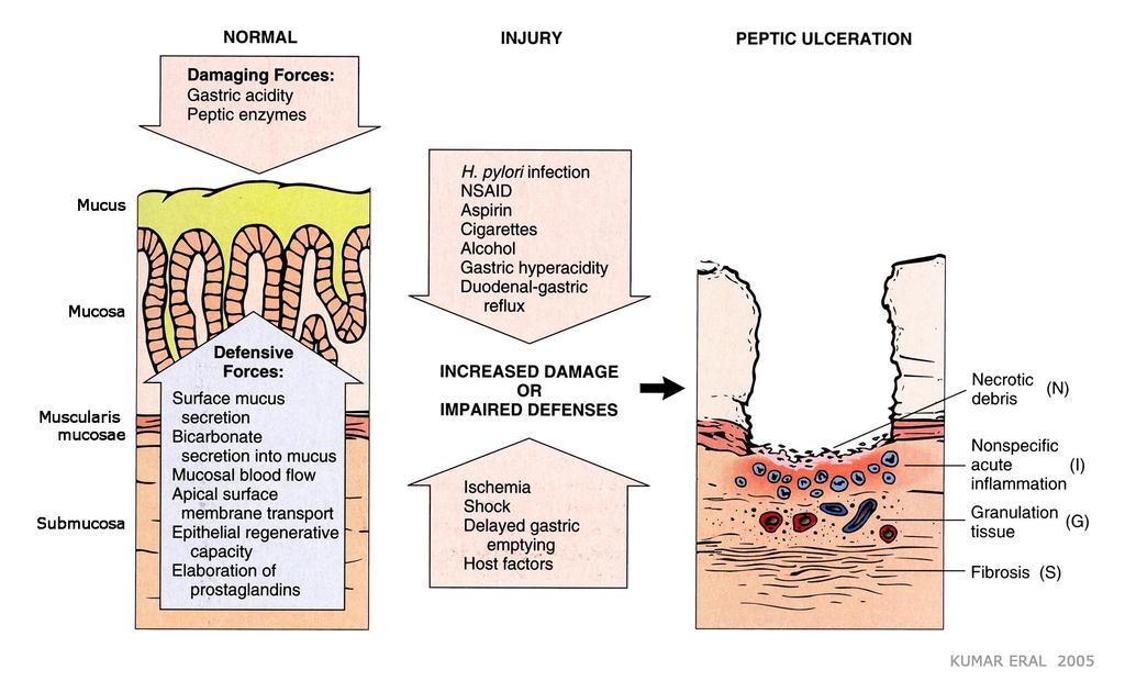 Schematic illustration of gastric ulcer formation in humans Robbins and