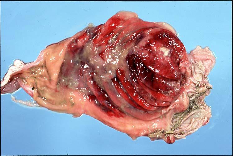 perfringens type A (Abomasitis with ulceration)
