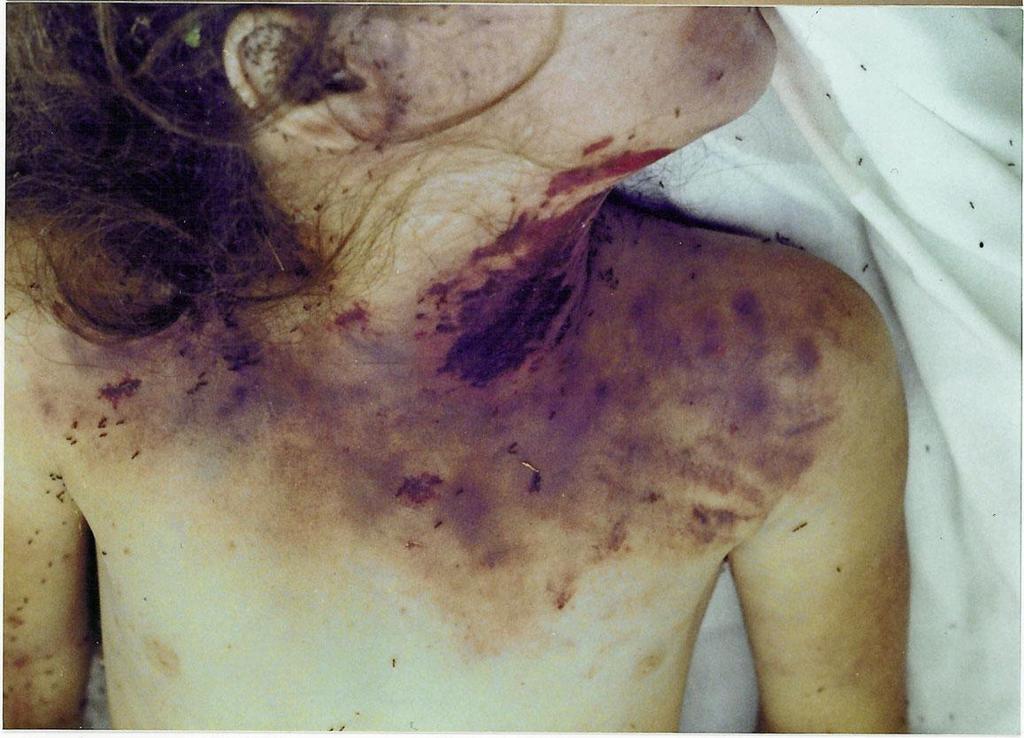FIGURE 11.9A This child victim of sexual homicide was discovered nude, beneath a blanket from her bedroom, in her backyard. She died from manual strangulation.