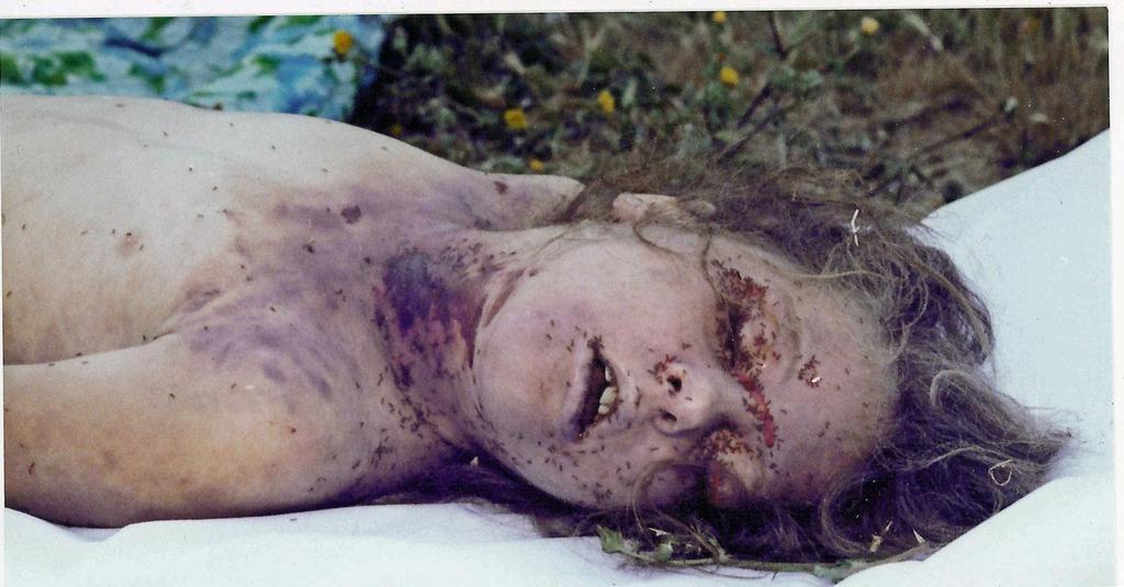 FIGURE 11.9B This child victim of sexual homicide was discovered nude, beneath a blanket from her bedroom, in her backyard. She died from manual strangulation.