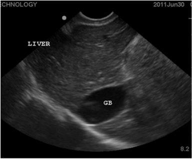 Ultrasound Diagnosed via ultrasound usually during an investigation for acute abdominal pain, vomiting, suspected liver or
