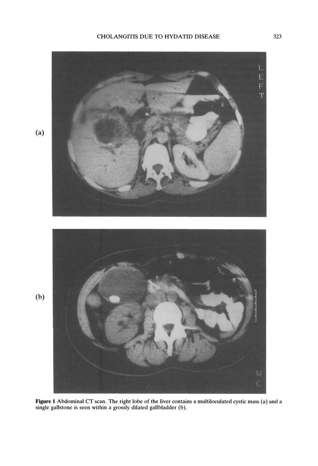 CHOLANGITIS DUE TO HYDATID DISEASE 323 (a) (b) Figure 1 Abdominal CT scan.