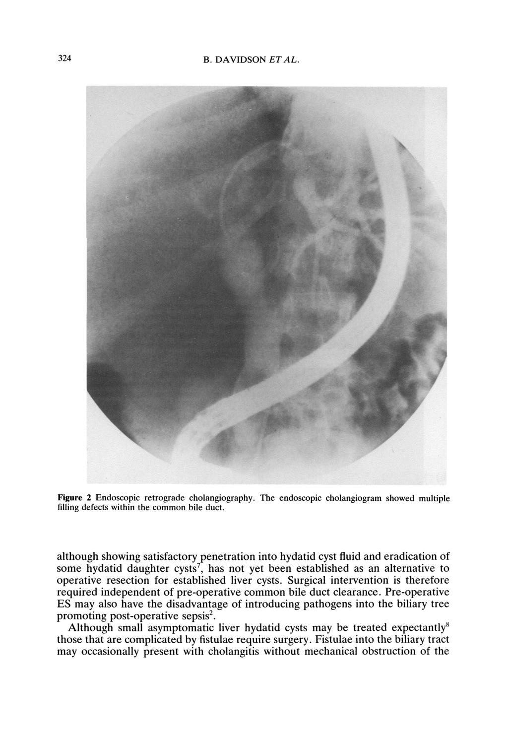 324 B. DAVIDSON ET AL. Figure 2 Endoscopic retrograde cholangiography. The endoscopic cholangiogram showed multiple filling defects within the common bile duct.