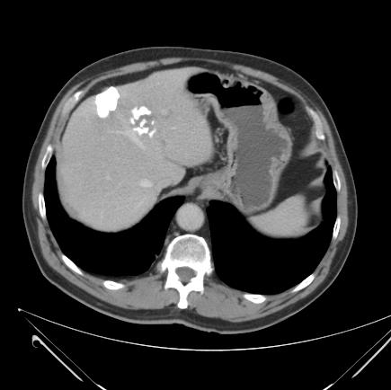 Giant hydatid cyst of the liver with a retroperitoneal growth: a case report. J Med Case Rep. 2012; 6: 298. SUGGESTED READING https://www.cdc.