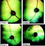 Retinal Degeneration Retinal Degeneration Progressive retinal atrophy in the Abyssinian Taurine Deficiency Essential amino acid needed for retinal health (primarily cones) cats do not synthesize