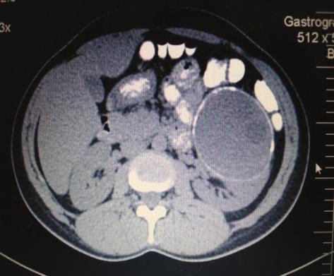 2 Case Reports in Urology Figure 1: CT imaging revealing the 14 cm left renal cystic mass. (a) Figure 2: Access to the left kidney through flank approach.