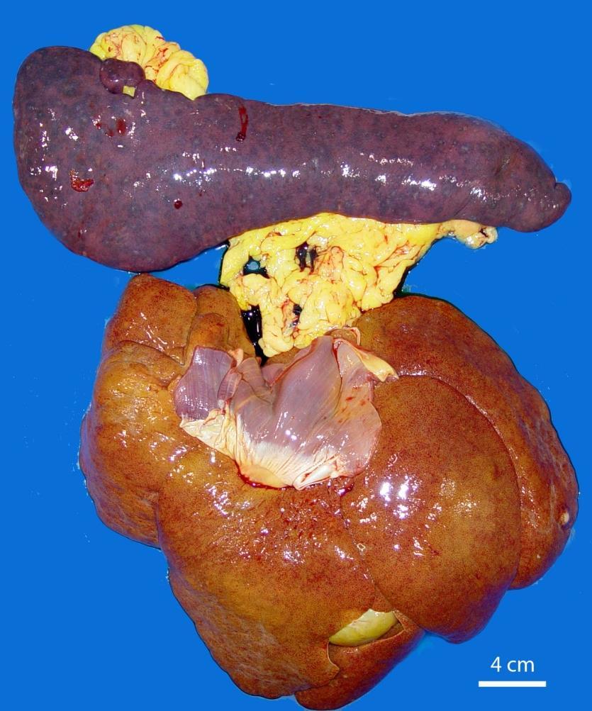 hepatomegaly Courtesy of Dr A Lopez,