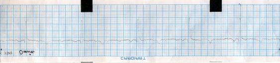 (a) Normal sinus rhythum before the administration of any