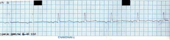 (a) Normal sinus rhythum before the administration