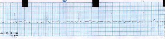 (a) Normal sinus rhythum before the administration of