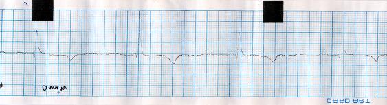 (a) Normal sinus rhythum before the administration