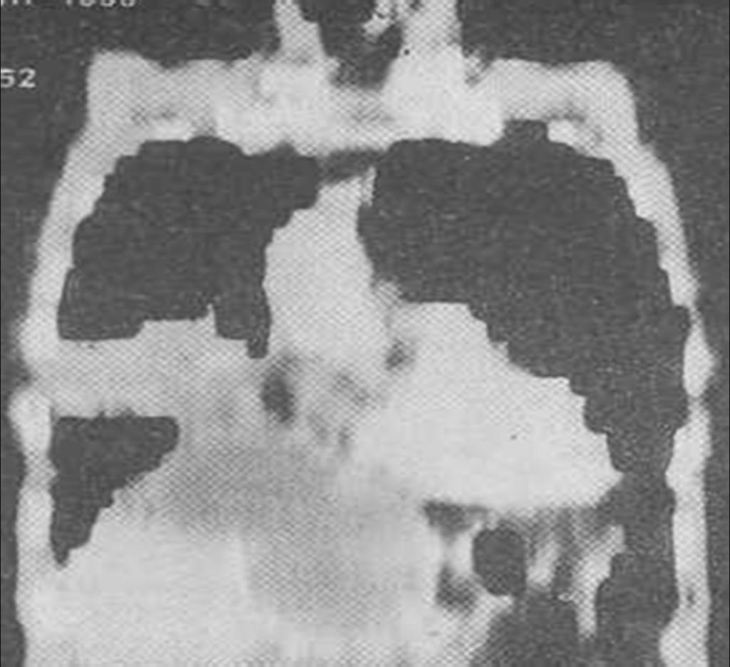 Fig. 8: Coronal CT MPR image showing