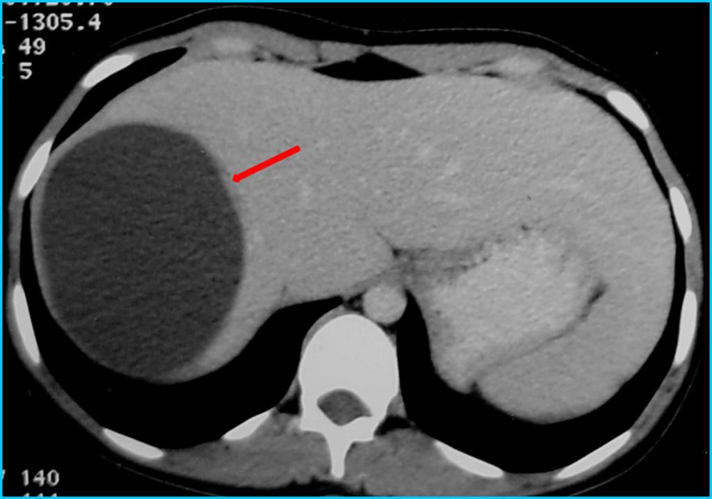 may be done in cases of occult rupture prior to interventions like PAIR to confirm biliary communication (Fig 7).
