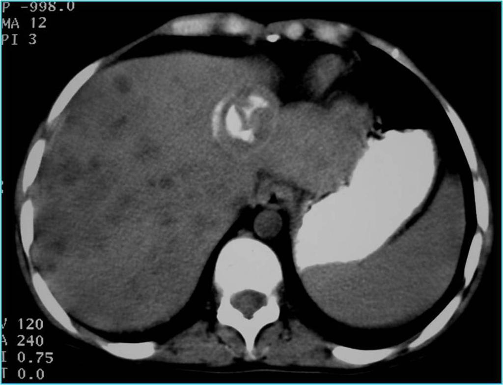 Fig. 2: A calcified hydatid cyst in left lobe along with multiple smaller hydatid cysts in