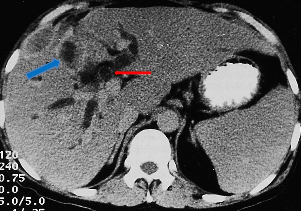 Fig. 3: Complications of ruptured hydatid cyst: Axial CT image showing dilated bile ducts with linear hyperdense membranes(red arrow)representing germinative membranes.