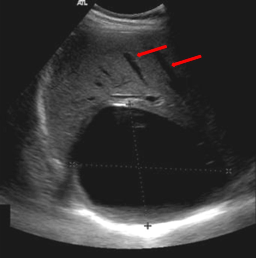 Fig. 6: Dilated ducts (Arrows) caused by compression