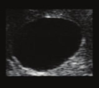 2 Case Reports in Medicine Figure 1: Ultrasound image of axillary cyst.