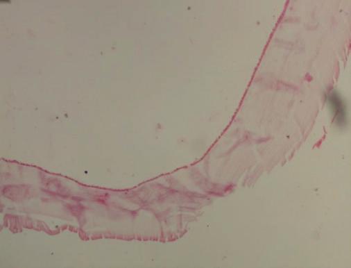 Case Reports in Medicine 3 Figure 2: Section of cyst wall showing germinal epithelium and underlying laminated membrane (haematoxylin-eosin stain, magnification 10).