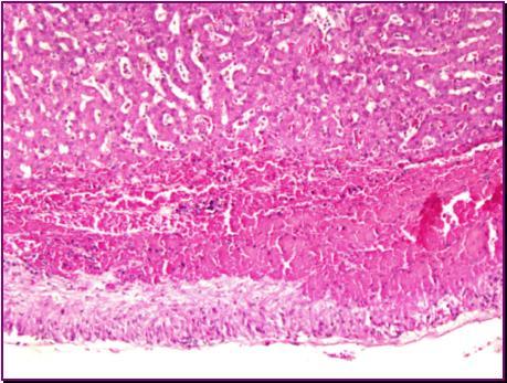 6 Figure 7. Intense reactive hyperplasia of glissonian mesothelium, with underlying haemorrhages. Haematoxylin-Eosin, 20X.
