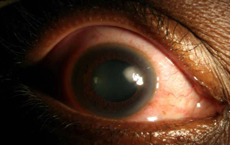S. maltophilia keratitis: A treatment challenge Resistant to the aminoglycosides and cephalosporins, which are