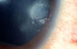 Edge of infiltrate < 3 mm from the center of cornea Vital, MC, Belloso M, Prager TC et al. Cornea. 26(1):16-2, January 27.