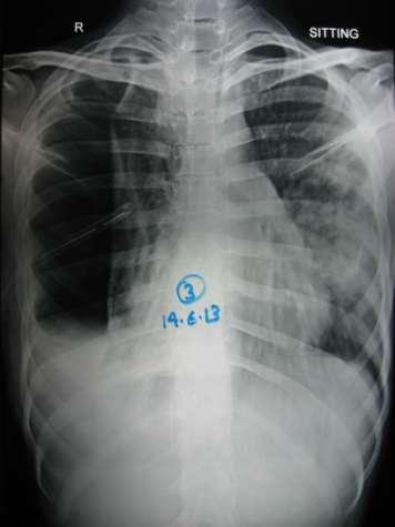 Serial Chest X ray at Surat Admitted from 14 Jun to 20 Jun in Surat