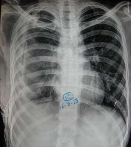 ICD Tube Inserted : 14 Sep 2013 Pleural Fluid : Turbid Protein: 5.
