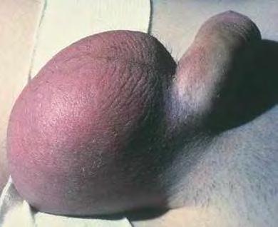 Scrotal pain and swelling with arthralgia,