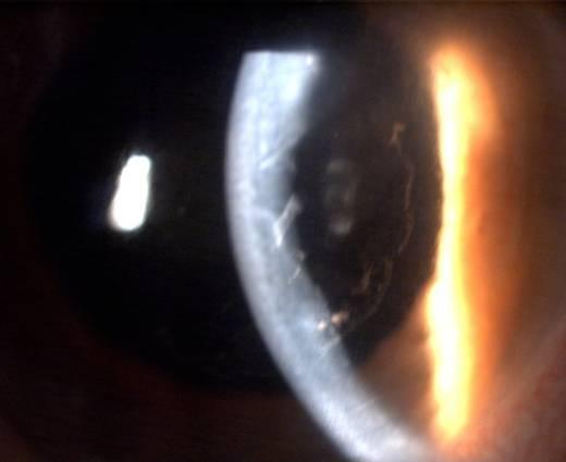 302 Cataract Surgery Fig. 1. Cornea oedema and fibrin on the IOL Inflammation can be very severe resulting in hypopyon and fibrin formation due to the leakage of the blood-aqueous barrier.