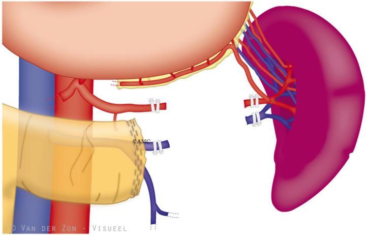 Laparoscopic distal pancreatectomy Most common indications: Carcinoma IPMN (main duct / side brach) Neuroendocrine tumor