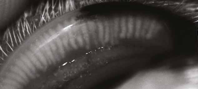 Pre-corneal Tear Film thickness and