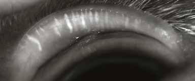 MGD alters the lipid component of the tear film and may cause evaporative dry eye with the typical signs of eye irritation, clinically apparent inflammation and OSD.