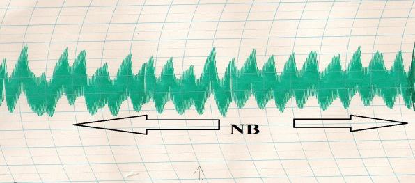 NB = Normal basal rhythm; Fig. 1: Tracing of Normal Saline P = Point of administration; NB= Normal basal rhythm Fig.