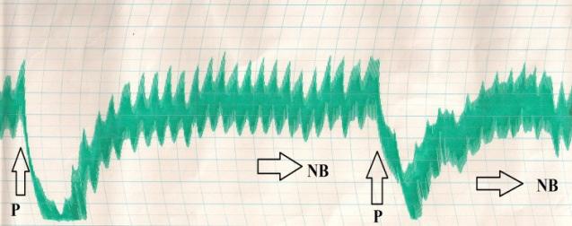 05 ml acetylcholine blocked by 0.1 ml of Atropine P = Point of administration; NB= Normal basal rhythm Fig.