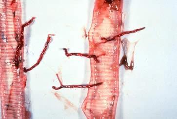 Trachea Worms Syngamus