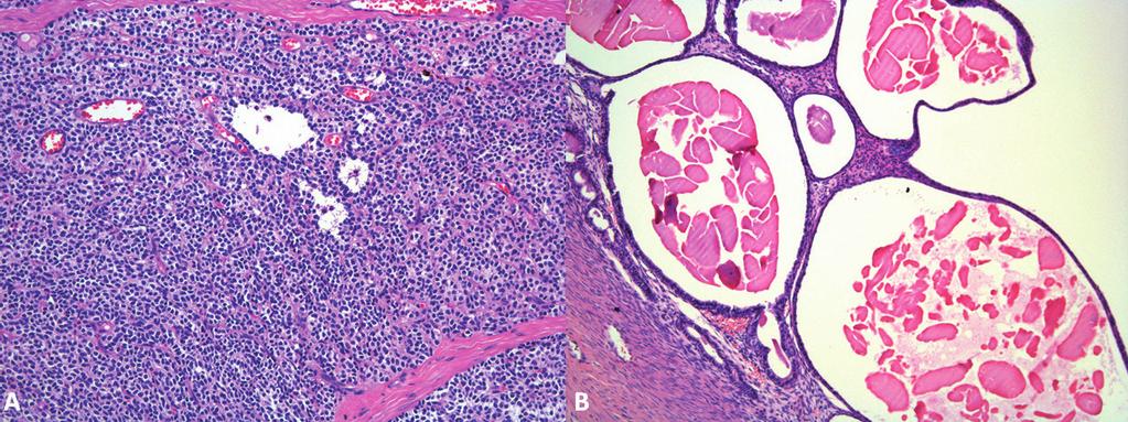 Figure 3. A- Ovarian granulosa cell tumor. Neoplastic tubular pattern proliferation with cystic multifocal formation [HE Obj. 200x]. B- Cystic endometrial hyperplasia.