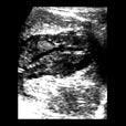 CE5- thick calcified cyst wall,causing a cone shaped shadow. Figure 1.3: Classification of ultrasound images.