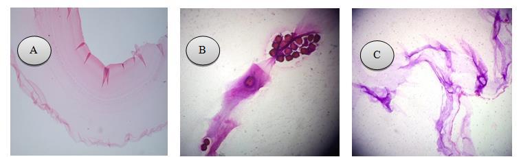 After bilateral oophorectomy, the cyst removed and sent to pathology laboratory. The pathology report confirmed hydatid cyst (Fig. 2).