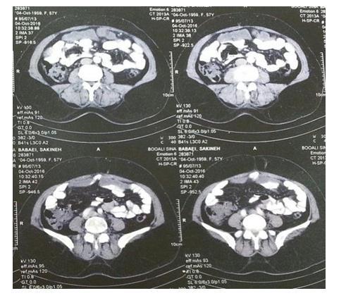CT scan performed for her indicated improvement of hydatidosis in liver but peritoan of this patient was full of many small hydatid cysts (Fig. 3). Albendazole for hydatidosis of peritoan continued.