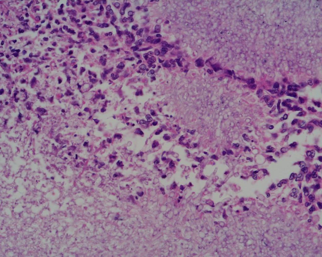 Fig 5.. Histology Section of omental nodule Haematoxylin and Eosin stain x 40 obj Fig 5 shows a close up of the large mat of fungal hyphae.