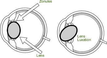 Primary Lens Luxation Zonules In the normal eye the lens is held in