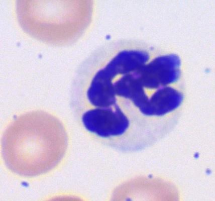 B) Neutrophil C) Monocyte We did not do any special staining, except Advia myeloperoxidase staining.