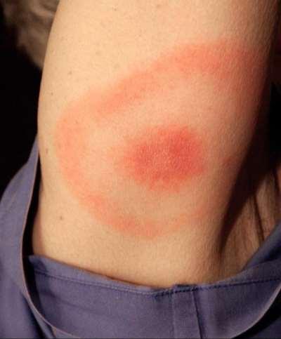 70% of infected persons have Erythema migrans (EM) rash Begins at the site of a tick bite