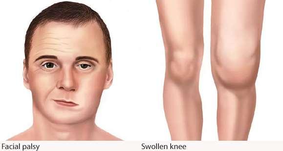 Weeks to months after infection Pain and swelling in the large joints Facial or Bell's palsy Shooting pains that may